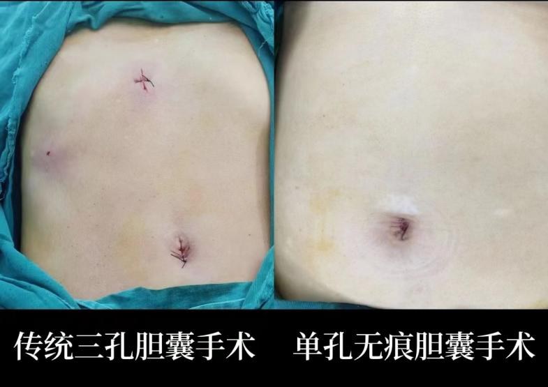 单孔腹腔镜手术配图