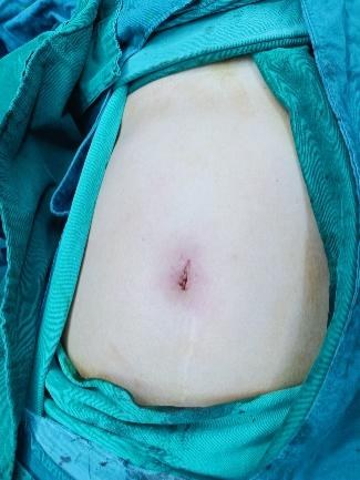 单孔免气腹腹腔镜手术配图
