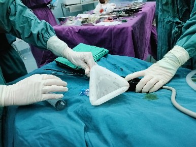 单孔免气腹腹腔镜手术配图