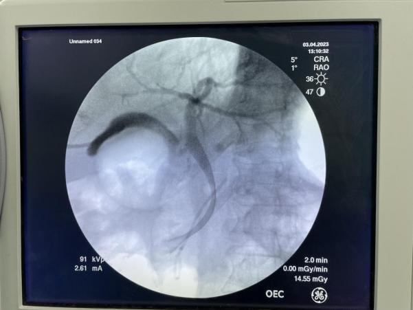 内镜下逆行胰胆管造影(ERCP)配图