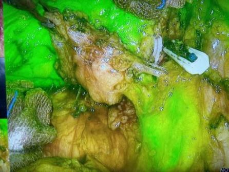 荧光腹腔镜技术配图